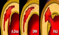 Acute aortic syn. Aha 2013