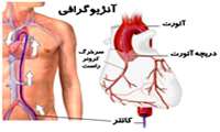 آشنایی با آنژیوگرافی قلب