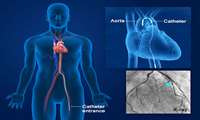 coronary angiogram