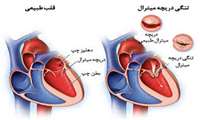 تنگی دریچه میترال