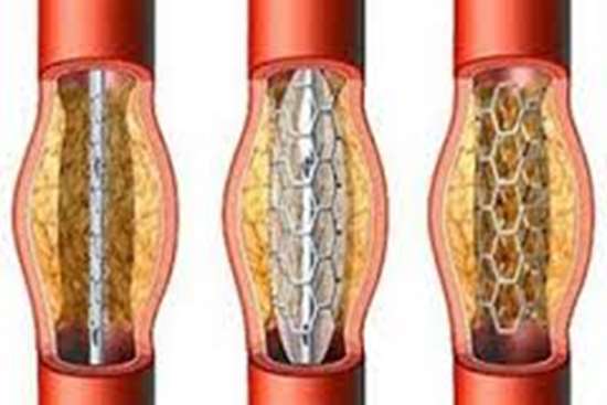 انواع استنت داخل عروق قلبی - کرونری -6,