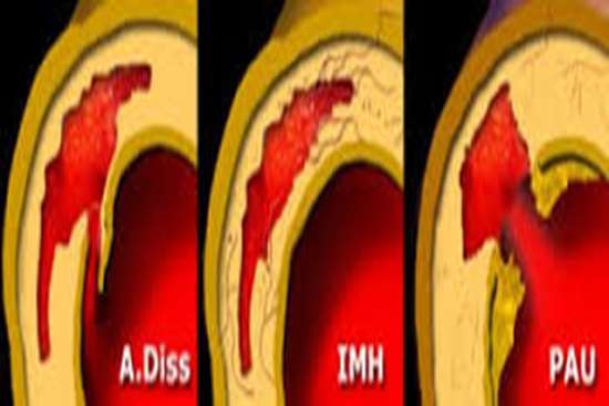 Acute aortic syn. Aha 2013 -6,